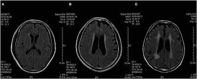 Cognitive Frailty Among Elderly Chinese Patients With Cerebral Small Vessel Disease: A Structural MRI Study